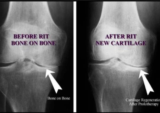 Aggiornamento didattico sulla proloterapia educativa. Qual è la differenza tra proloterapia e cortisone? <b>01/04/2018</b>